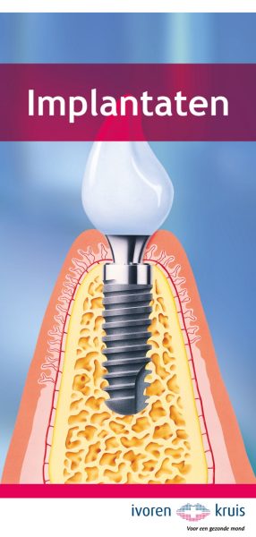Folder Implantaten